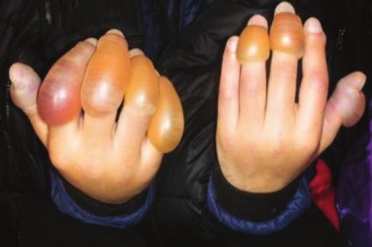FROSTBITE injuries to the hands can be lifechanging. NATIONAL PARK SERVICE